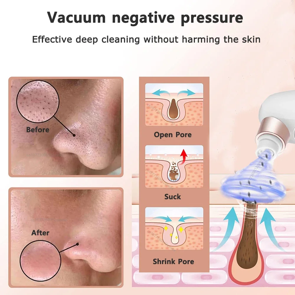 Removedor de espinillas, aspirador de poros, limpiador facial el&eacute;ctrico, espinillas, acn&eacute;, eliminaci&oacute;n de cabeza negra, recargable por USB, ciclo de agua, eliminaci&oacute;n de puntos negros